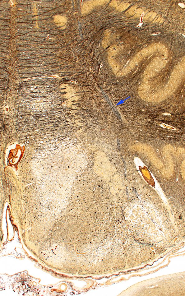 5B4 Infarct, Pyramid (Case 5) Biels 4X 2 copy