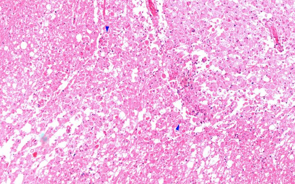 5C1 Infarct, Pyramid (Case 5) H&E 10X copy