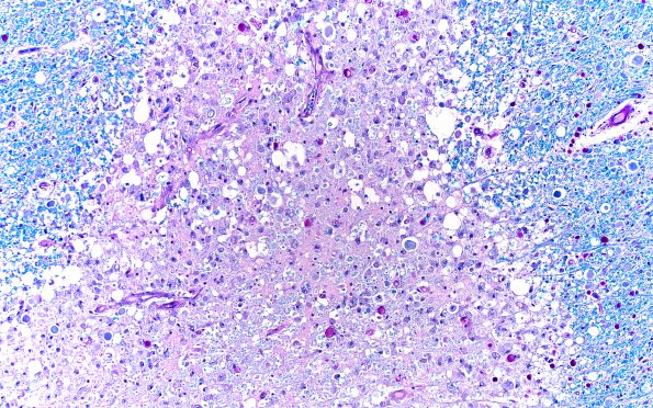 5C2 Infarct, Pyramid (Case 5) LFB-PAS 10X 2