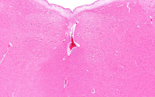 5D1 Infarct, Pyramid (Case 5) H&E 4X XIInuclei