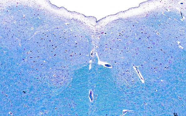 5D2 Infarct, Pyramid (Case 5) LFB-PAS 4X