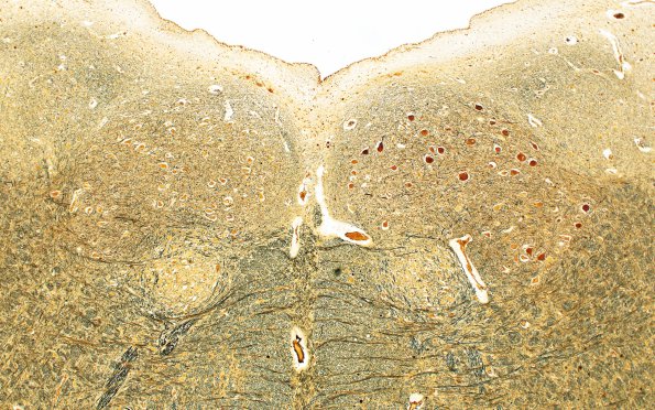 5D3 Infarct, Pyramid (Case 5) Biels 4X 3