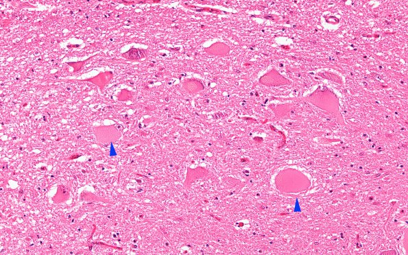 5E1 Infarct, Pyramid (Case 5) H&E 10X XIInuclei L copy