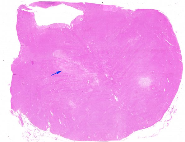 6A1 Infarct, Lacunar (Case 6) H&E WM copy