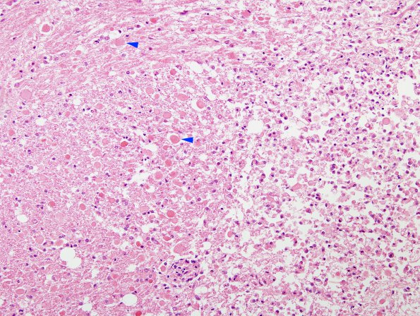 6A2 Infarct, Lacunar (Case 6) H&E copy