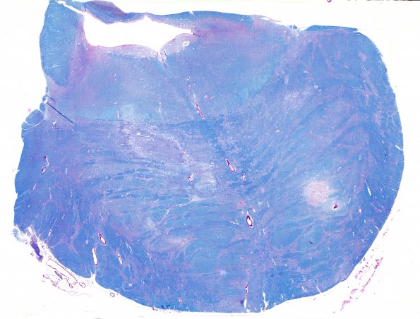 6B1 Infarct, Lacunar (Case 6) LFB-PAS WM