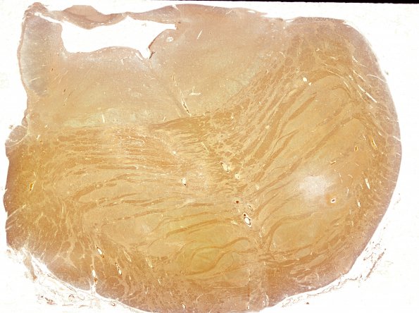 6C1 Infarct, Lacunar (Case 6) Biels WM