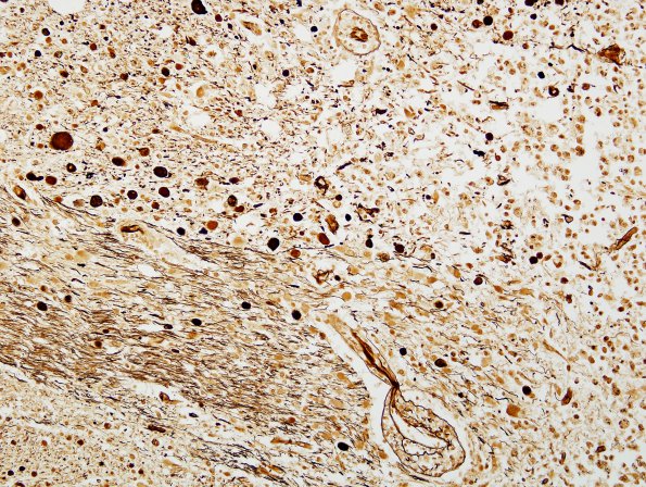 6C3 Infarct, Lacunar (Case 6) Biels 2