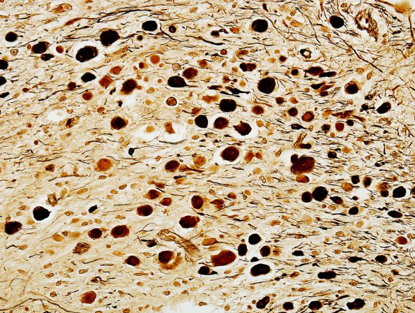 6C4 Infarct, Lacunar (Case 6) Biels 1