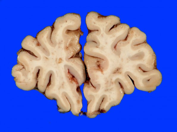 7A1 Infarcts, HT-DM (Case 7) Gross_4