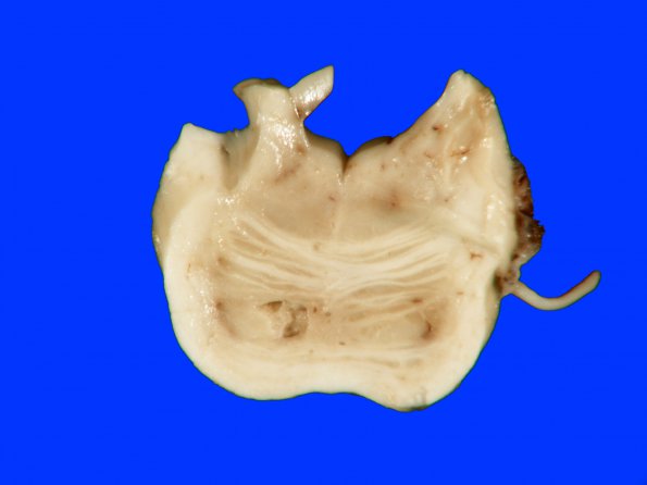 7A2 Infarcts, HT-DM (Case 7) Gross_12