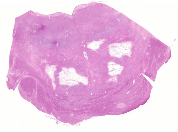 7B1 Infarcts, HT-DM (Case 7) H&E WM