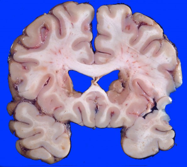 8A1 Infarcts, lacunar, chronic (Case 8) 4