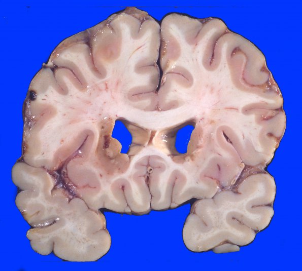 8A3 Infarcts, lacunar, chronic (Case 8) 5