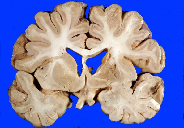 9A1 Infarct, Lacunar (Case 9A1) 2