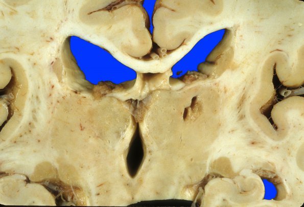 9B Infarct, lacunar (Case 9B)