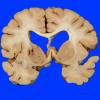 9C1 Infarct, lacunar (Case 9C1) 1