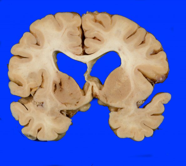 9C1 Infarct, lacunar (Case 9C1) 1