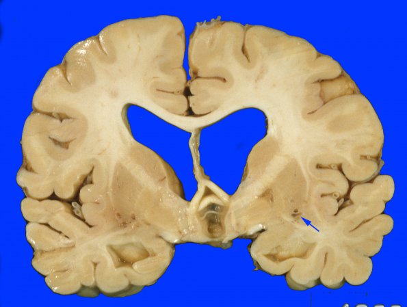 9C2 Infarct, lacunar (Case 9C2) 2 copy