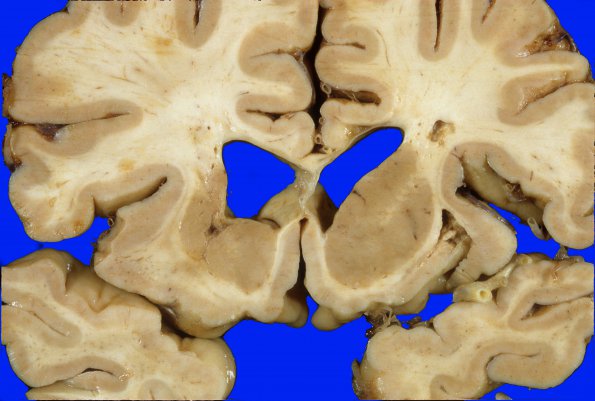 9D Infarcts, lacunar (Case 9D) 2