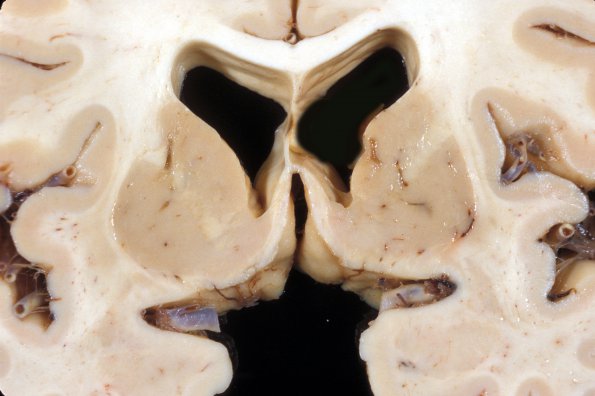 9E1 Infarct, Lacunar (Case 9E1) b