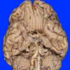 10A1 Infarct, Lateral Medullary, remote (Case 10) gross