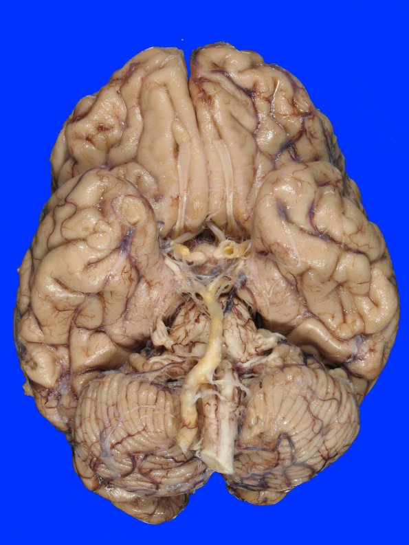 10A1 Infarct, Lateral Medullary, remote (Case 10) gross