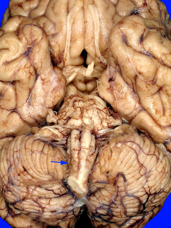 10A2 Infarct, Lateral Medullary, remote (Case 10) 1 copy