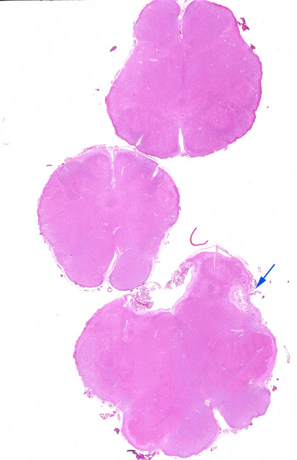 10B1 Infarct, old, lateral medullary syndrome (Case 10) H&E whole mount copy