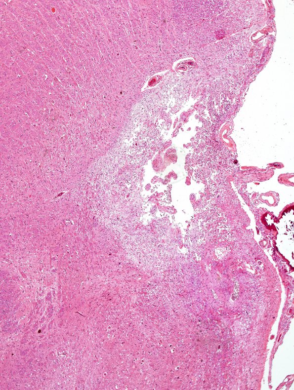 10B2 Infarct, old, lateral medullary syndrome (Case 10) H&E 1