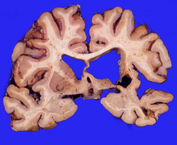 11A1 Infarct, remote (Case 11) 1