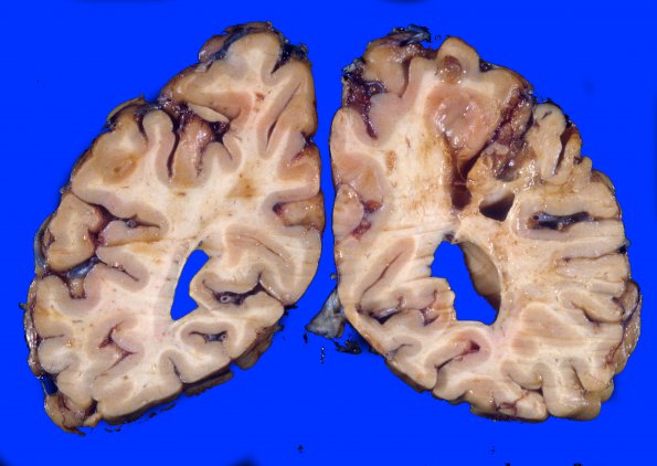 11A2 Infarct, remote (Case 11) 2