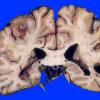 11A3 Infarct, remote (Case 11) 3