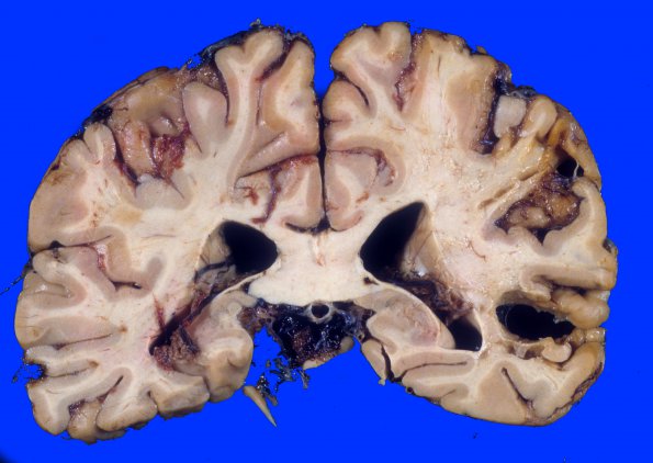 11A3 Infarct, remote (Case 11) 3