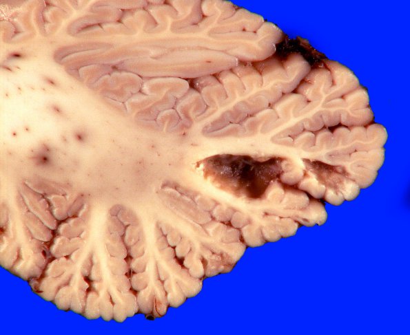 12A1 Infarct, remote, (Case 12) _3