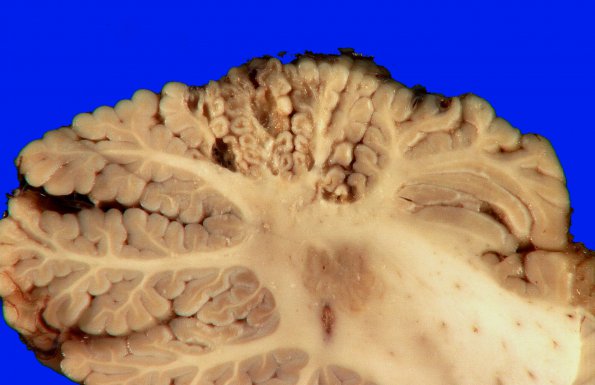 12A3 Infarct, remote, (Case 12) _2