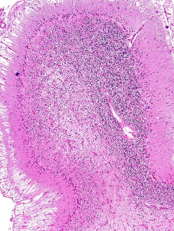 12B2 Infarct, remote, (Case 12) H&E 3