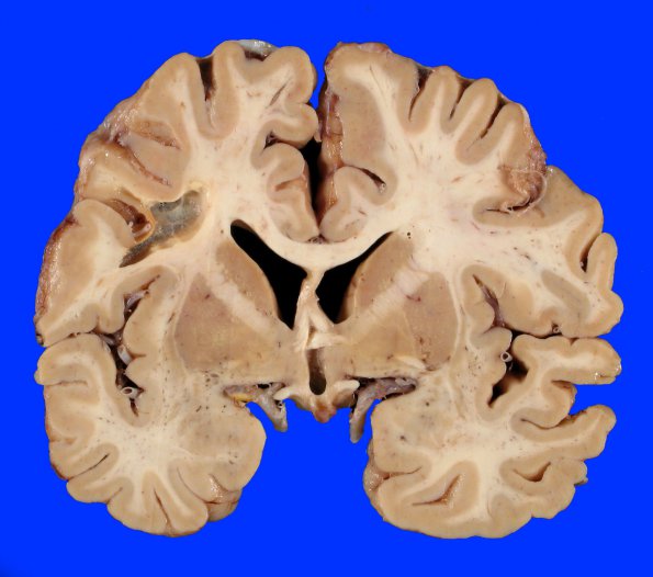 13A1 Infarct, Remote (Case 13) N 07