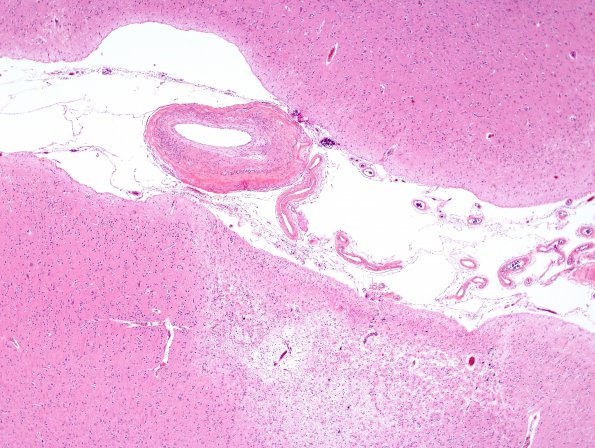 14B2 Infarct, remote (Case 14) H&E 4