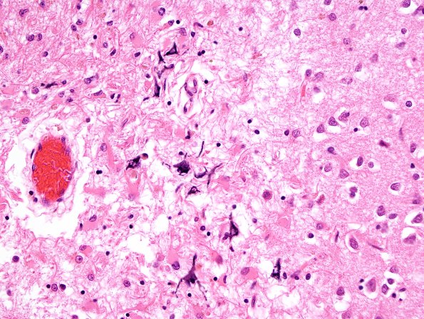 14B5 Infarct, remote (Case 14) H&E 1