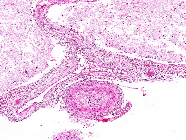 15A2 Infarct, spinal cord (Case 15) H&E 5