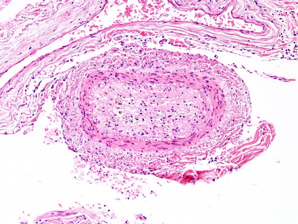 15A3 Infarct, spinal cord (Case 15) H&E 4