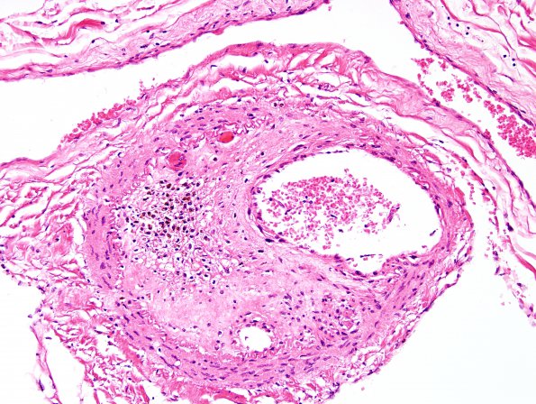 15A4 Infarct, spinal cord (Case 15) H&E 2