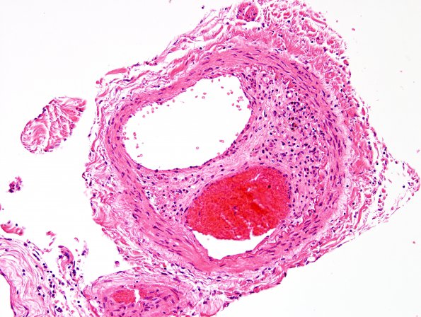 15A5 Infarct, spinal cord (Case 15) H&E 3