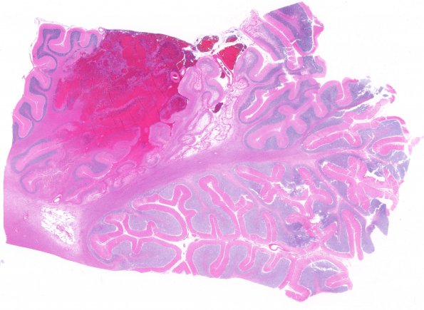 16B1 Infarcts (Case 16) H&E 6