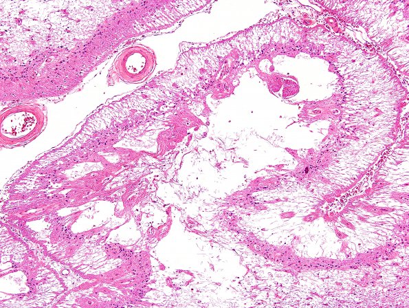 16B2 Infarcts (Case 16) H&E 17