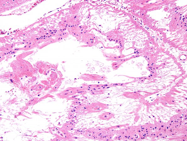 16B3 Infarcts (Case 16) H&E 18