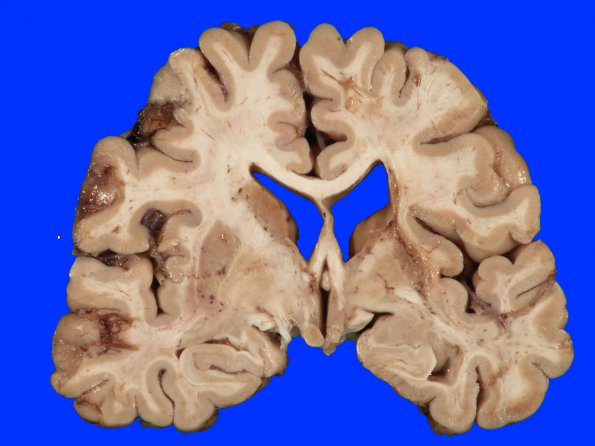 18A1 Infarct, remote (Case 18)_1