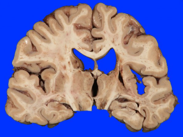 18A2 Infarct, remote (Case 18)_2