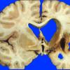 19A1 Infarct, remote, hemorrhagic (Case 19)